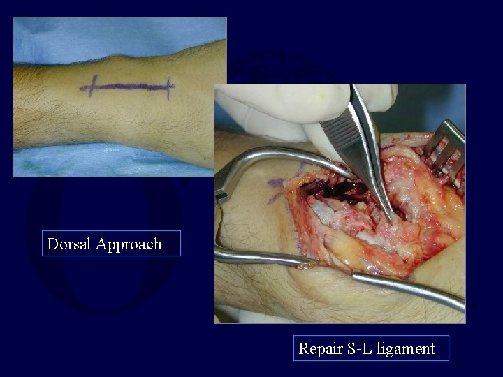 Dorsal Approach Repair S-L ligament 