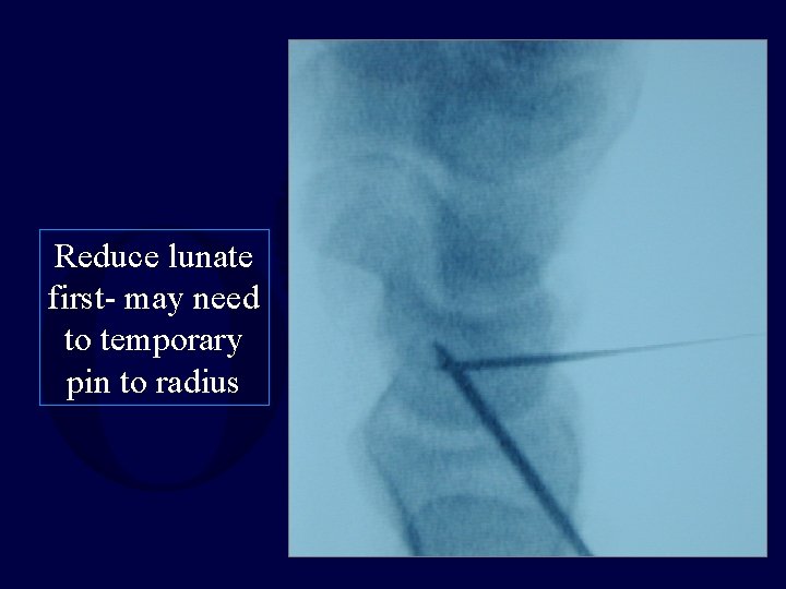 Reduce lunate first- may need to temporary pin to radius 