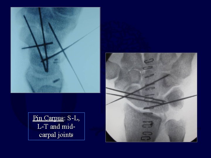 Pin Carpus: S-L, L-T and midcarpal joints 