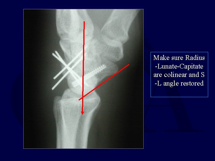 Make sure Radius -Lunate-Capitate are colinear and S -L angle restored 