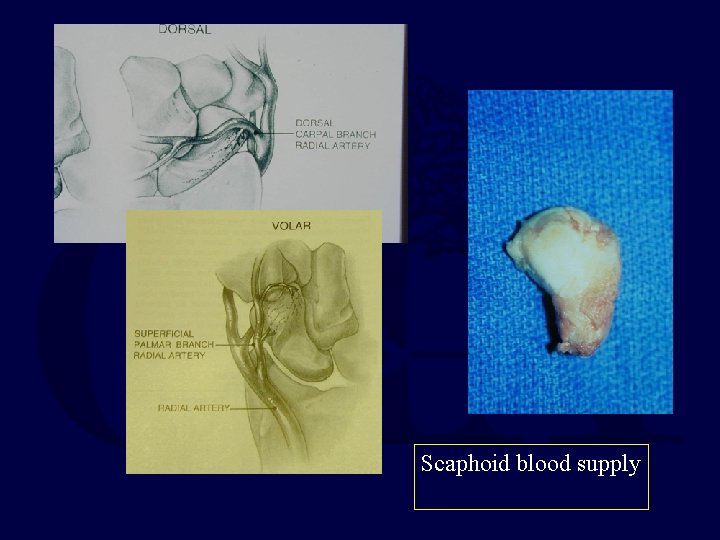 Scaphoid blood supply 