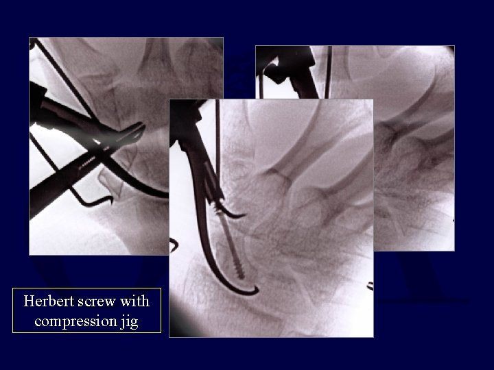 Herbert screw with compression jig 