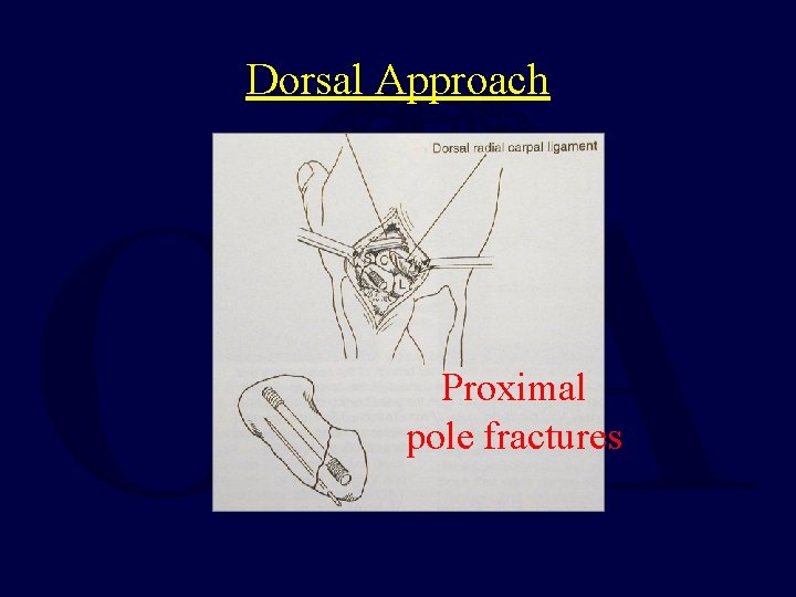 Dorsal Approach Proximal pole fractures 