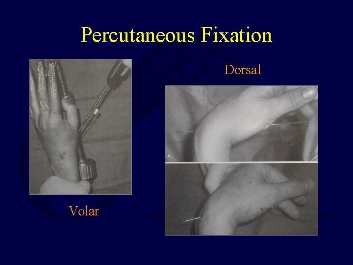 Percutaneous Fixation Dorsal Volar 