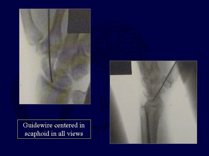 Guidewire centered in scaphoid in all views 