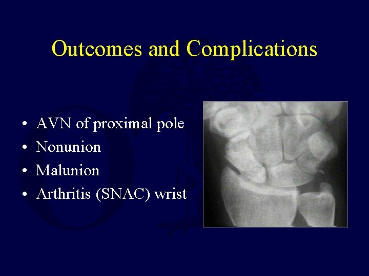 Outcomes and Complications • • AVN of proximal pole Nonunion Malunion Arthritis (SNAC) wrist