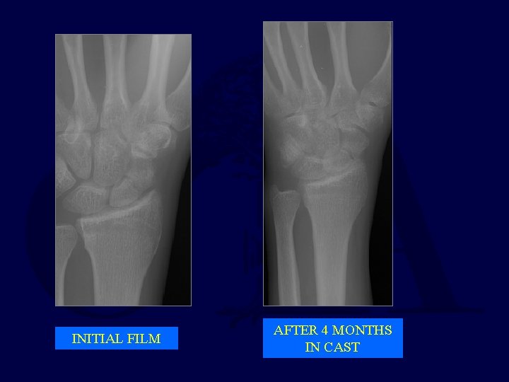 INITIAL FILM AFTER 4 MONTHS IN CAST 