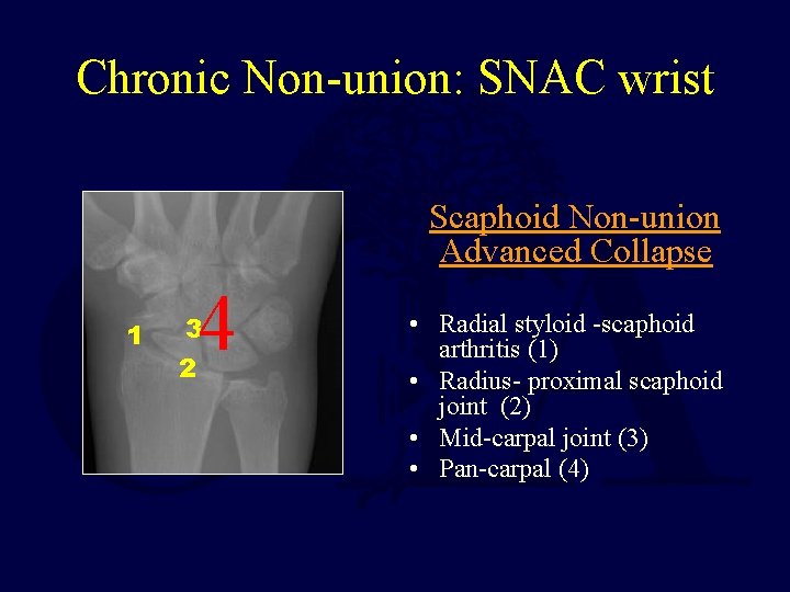 Chronic Non-union: SNAC wrist Scaphoid Non-union Advanced Collapse 1 4 3 2 • Radial