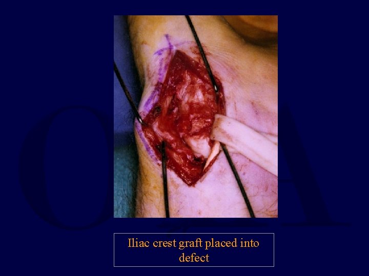 Iliac crest graft placed into defect 