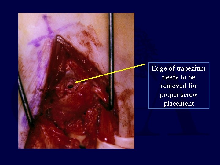 Edge of trapezium needs to be removed for proper screw placement 