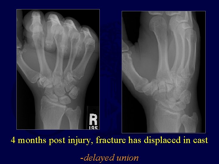 4 months post injury, fracture has displaced in cast -delayed union 