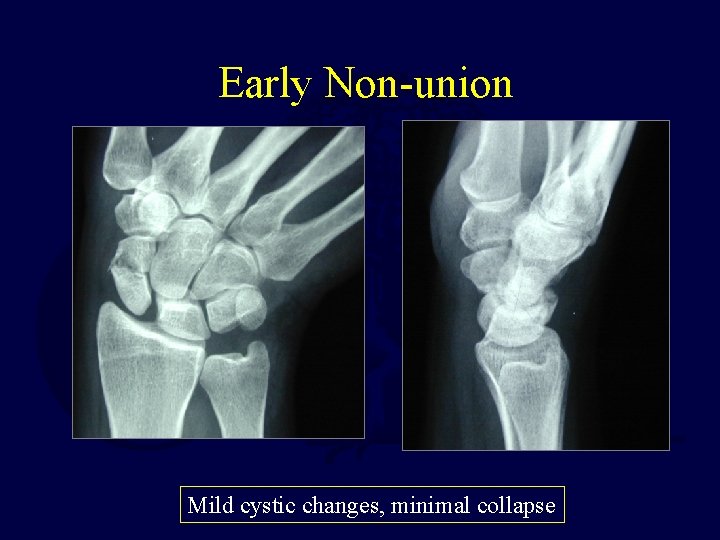 Early Non-union Mild cystic changes, minimal collapse 