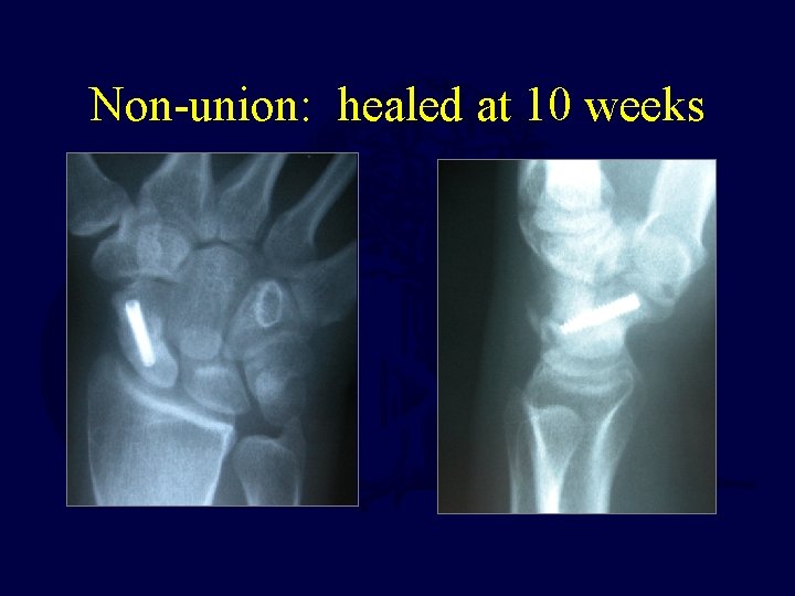 Non-union: healed at 10 weeks 