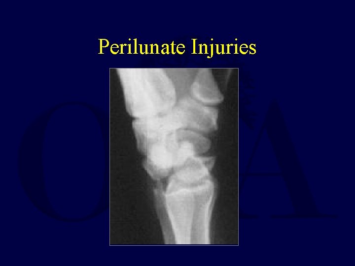 Perilunate Injuries 