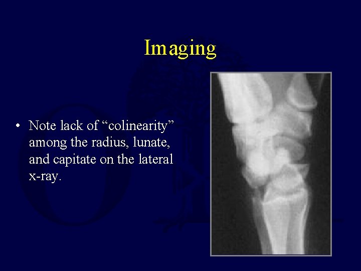 Imaging • Note lack of “colinearity” among the radius, lunate, and capitate on the