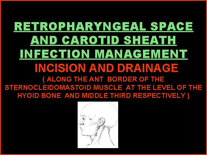 RETROPHARYNGEAL SPACE AND CAROTID SHEATH INFECTION MANAGEMENT INCISION AND DRAINAGE ( ALONG THE ANT
