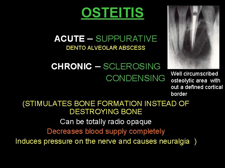 OSTEITIS ACUTE – SUPPURATIVE DENTO ALVEOLAR ABSCESS CHRONIC – SCLEROSING CONDENSING Well circumscribed osteolytic