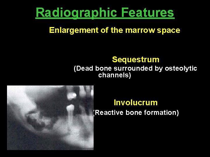 Radiographic Features Enlargement of the marrow space Sequestrum (Dead bone surrounded by osteolytic channels)