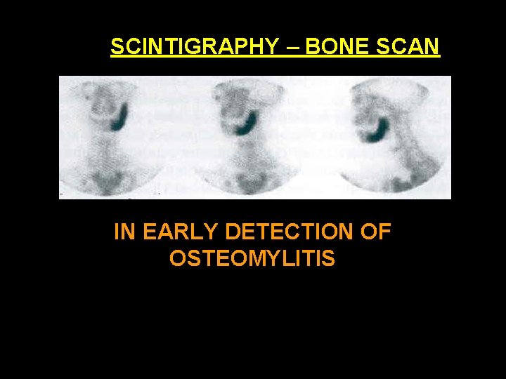 SCINTIGRAPHY – BONE SCAN IN EARLY DETECTION OF OSTEOMYLITIS 