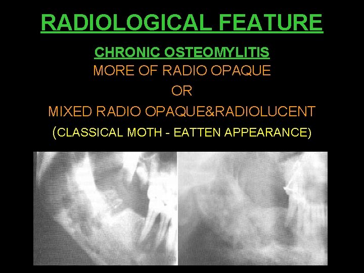 RADIOLOGICAL FEATURE CHRONIC OSTEOMYLITIS MORE OF RADIO OPAQUE OR MIXED RADIO OPAQUE&RADIOLUCENT (CLASSICAL MOTH