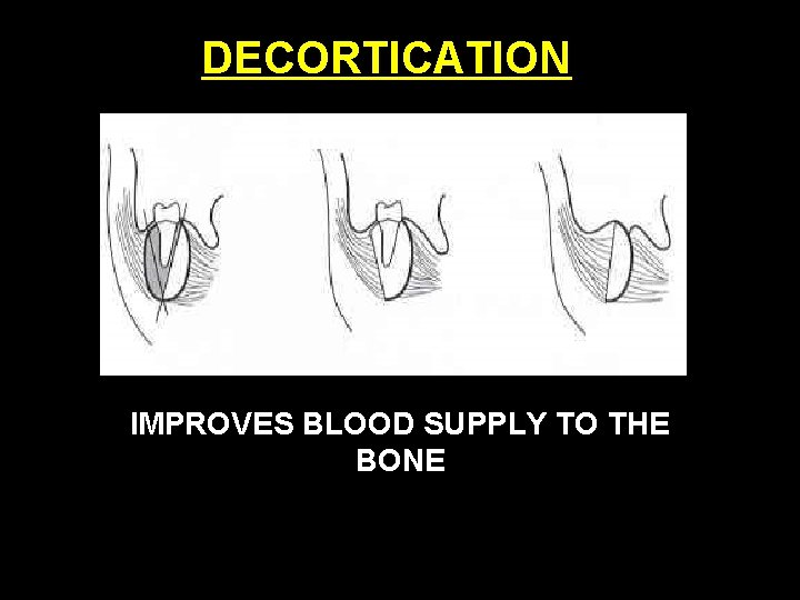 DECORTICATION IMPROVES BLOOD SUPPLY TO THE BONE 