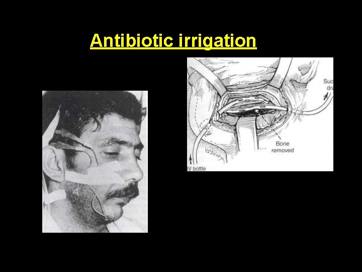 Antibiotic irrigation 