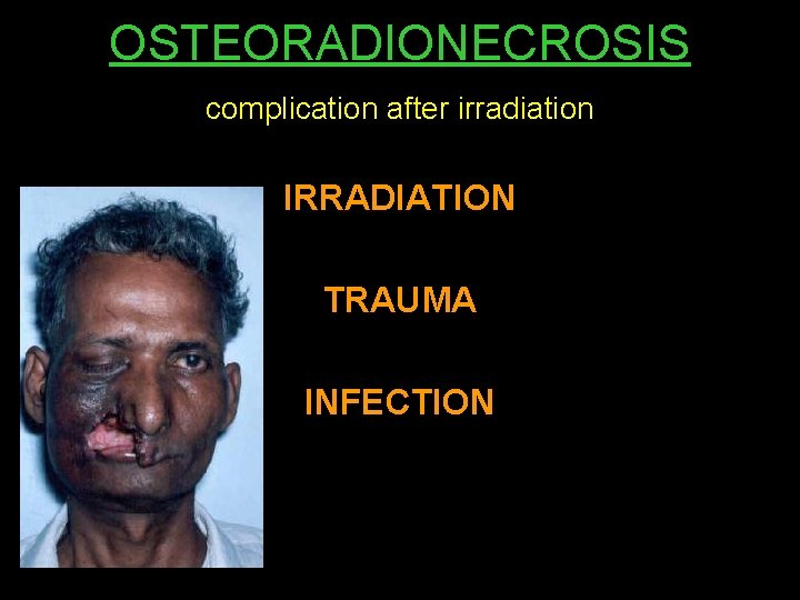OSTEORADIONECROSIS complication after irradiation IRRADIATION TRAUMA INFECTION 