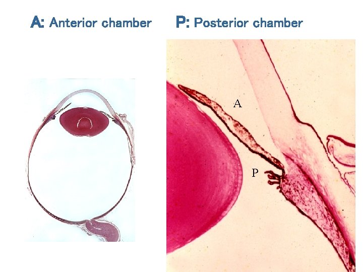 A: Anterior chamber P: Posterior chamber A P 