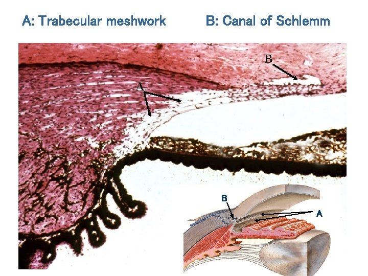 A: Trabecular meshwork B: Canal of Schlemm B A 