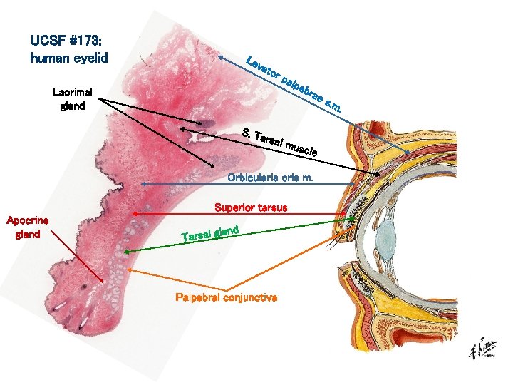 UCSF #173: human eyelid Lev ato r Lacrimal gland pal peb rae . S.