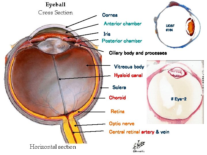 Cornea Anterior chamber Iris Posterior chamber UCSF #164 Ciliary body and processes Vitreous body