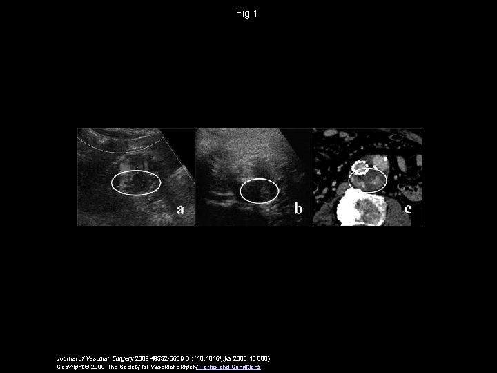 Fig 1 Journal of Vascular Surgery 2009 49552 -560 DOI: (10. 1016/j. jvs. 2008.