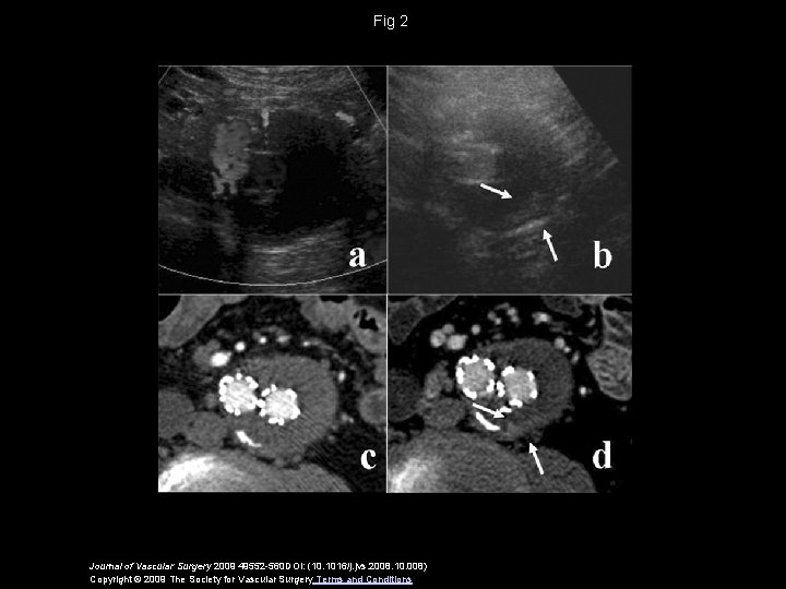 Fig 2 Journal of Vascular Surgery 2009 49552 -560 DOI: (10. 1016/j. jvs. 2008.