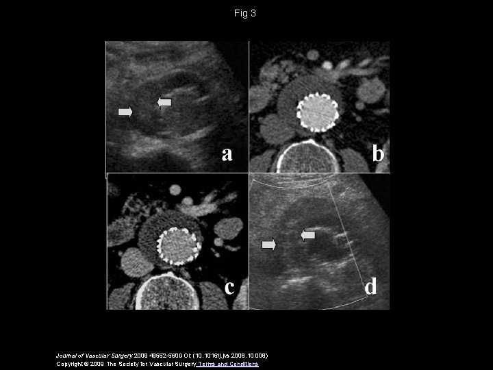 Fig 3 Journal of Vascular Surgery 2009 49552 -560 DOI: (10. 1016/j. jvs. 2008.