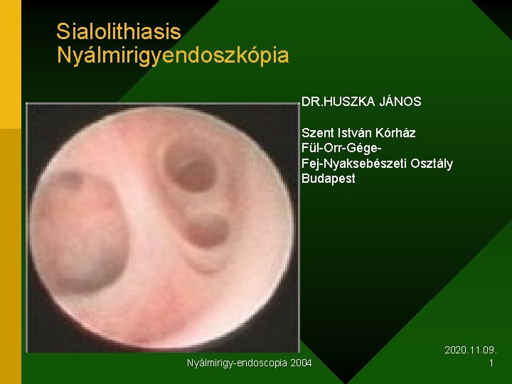 Sialolithiasis Nyálmirigyendoszkópia DR. HUSZKA JÁNOS Szent István Kórház Fül-Orr-Gége. Fej-Nyaksebészeti Osztály Budapest Nyálmirigy-endoscopia 2004