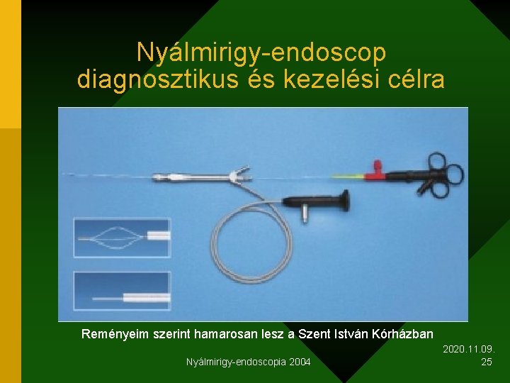 Nyálmirigy-endoscop diagnosztikus és kezelési célra Reményeim szerint hamarosan lesz a Szent István Kórházban Nyálmirigy-endoscopia