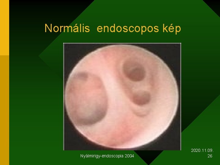 Normális endoscopos kép Nyálmirigy-endoscopia 2004 2020. 11. 09. 26 