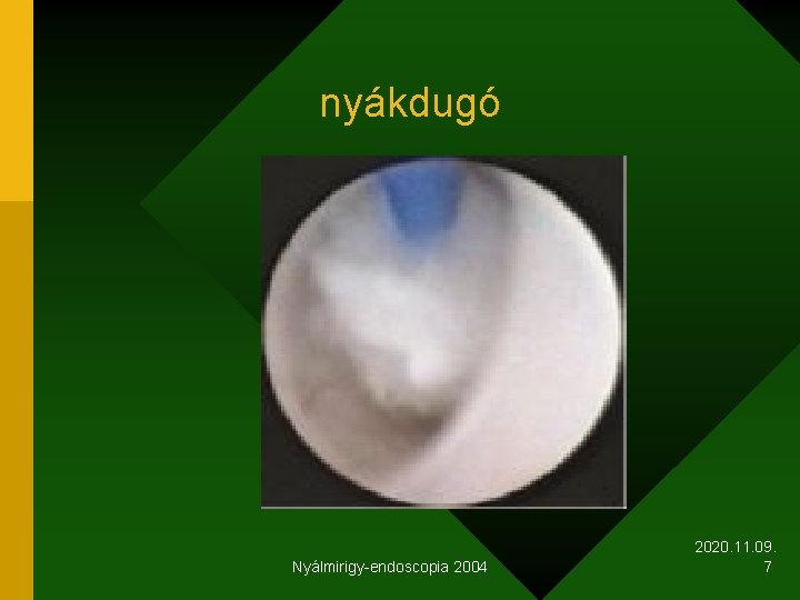 nyákdugó Nyálmirigy-endoscopia 2004 2020. 11. 09. 7 