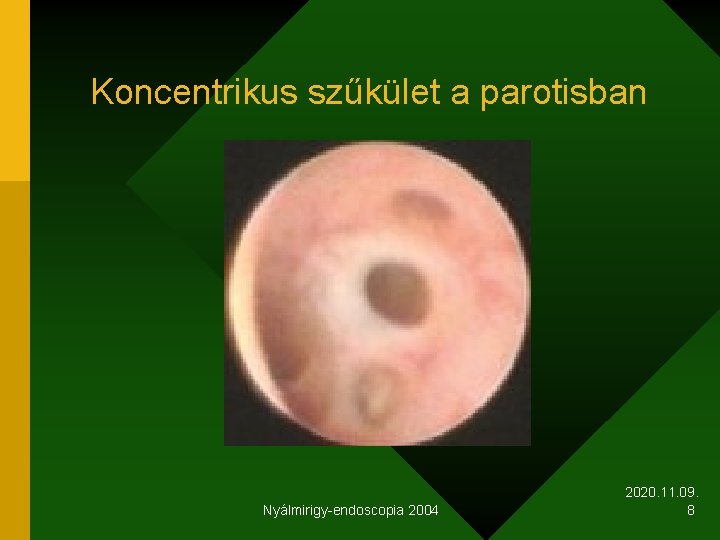 Koncentrikus szűkület a parotisban Nyálmirigy-endoscopia 2004 2020. 11. 09. 8 