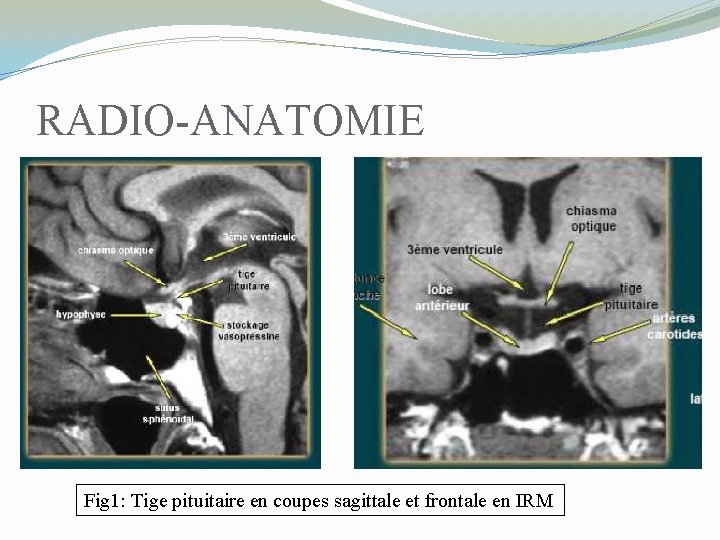 RADIO-ANATOMIE Fig 1: Tige pituitaire en coupes sagittale et frontale en IRM 