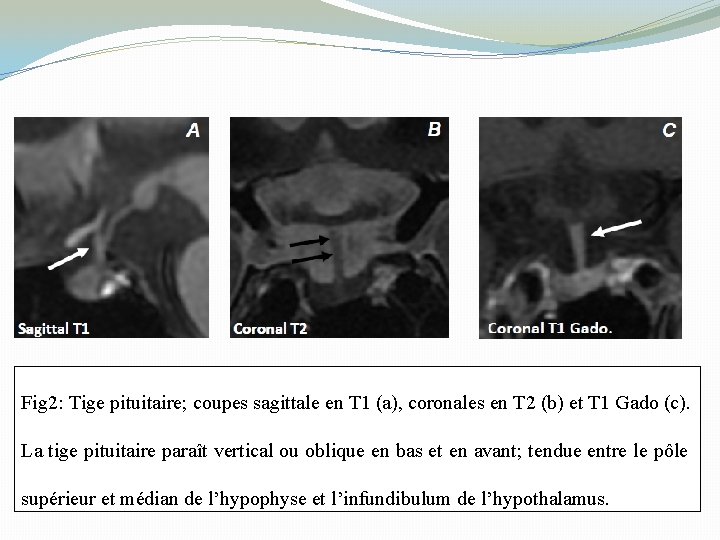 Fig 2: Tige pituitaire; coupes sagittale en T 1 (a), coronales en T 2