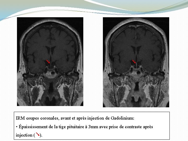 IRM coupes coronales, avant et après injection de Gadolinium: • Épaississement de la tige