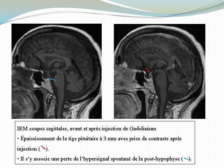 IRM coupes sagittales, avant et après injection de Gadolinium • Épaississement de la tige