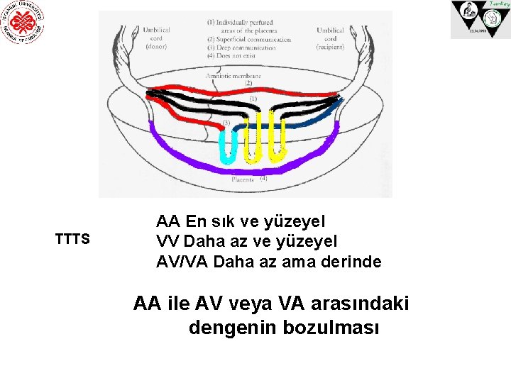 TTTS AA En sık ve yüzeyel VV Daha az ve yüzeyel AV/VA Daha az