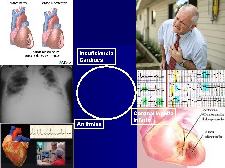 Insuficiencia Cardíaca Arritmias Coronariopatía Infarto 