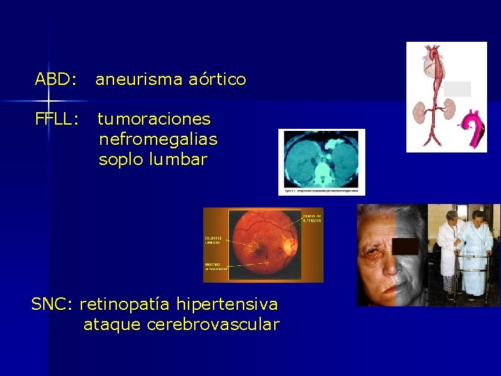 ABD: aneurisma aórtico FFLL: tumoraciones nefromegalias soplo lumbar SNC: retinopatía hipertensiva ataque cerebrovascular 