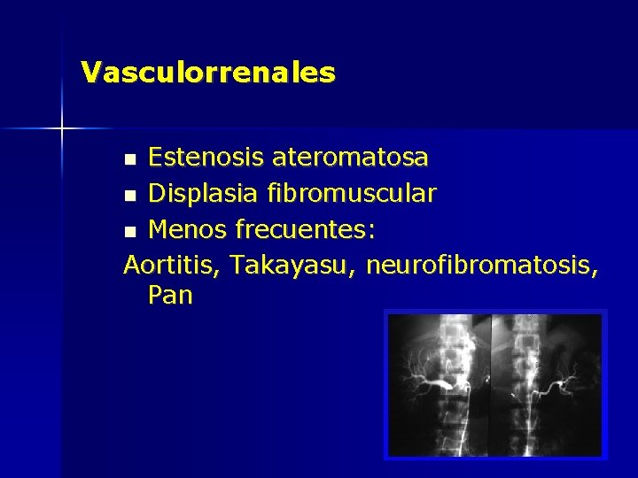 Vasculorrenales Estenosis ateromatosa Displasia fibromuscular Menos frecuentes: Aortitis, Takayasu, neurofibromatosis, Pan 