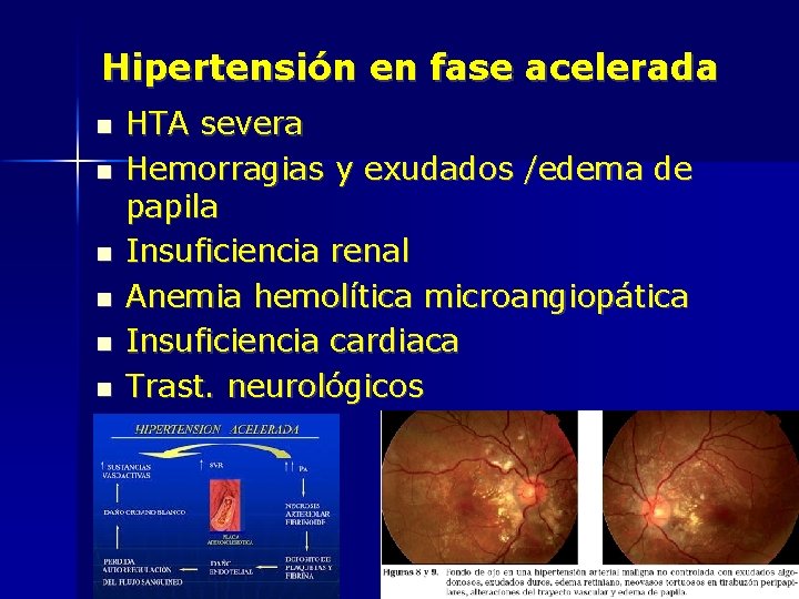 Hipertensión en fase acelerada HTA severa Hemorragias y exudados /edema de papila Insuficiencia renal