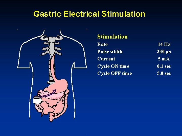 Gastric Electrical Stimulation Rate Pulse width Current Cycle ON time Cycle OFF time 14