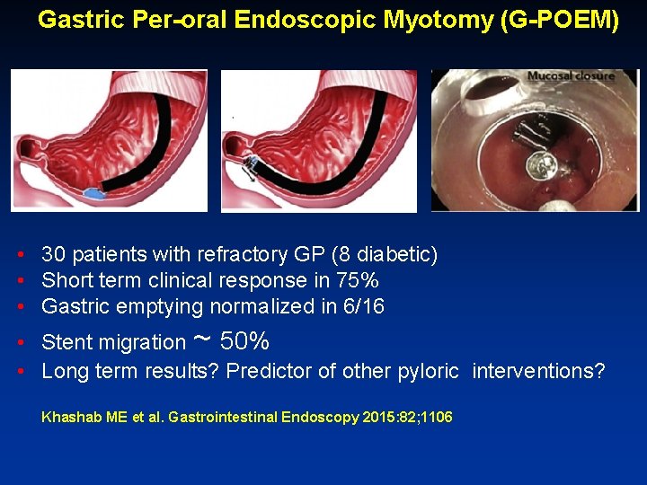 Gastric Per-oral Endoscopic Myotomy (G-POEM) • 30 patients with refractory GP (8 diabetic) •